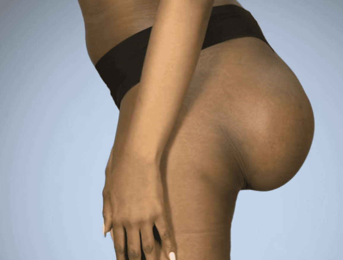 Botched Butt Surgery (video)