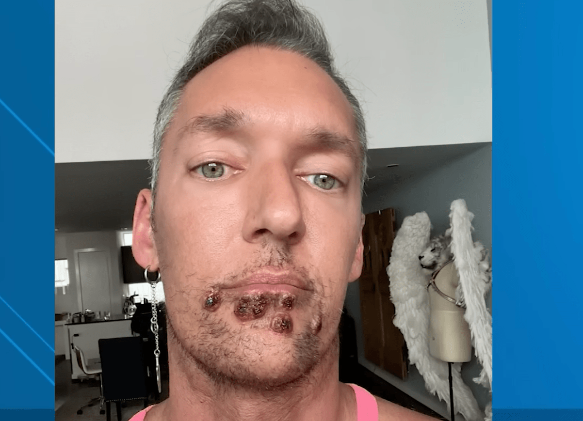 Houston Man with Monkeypox Says "It Hurts to Exist" (Video)