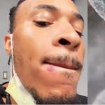 Houston Man in Final Stages of Monkeypox Ready to Get his Life Back (video)